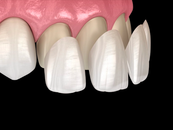 Dental Veneers & Laminates